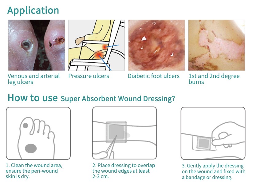 Absorbent dressing superabsorbent dressing absorbs wound exudate