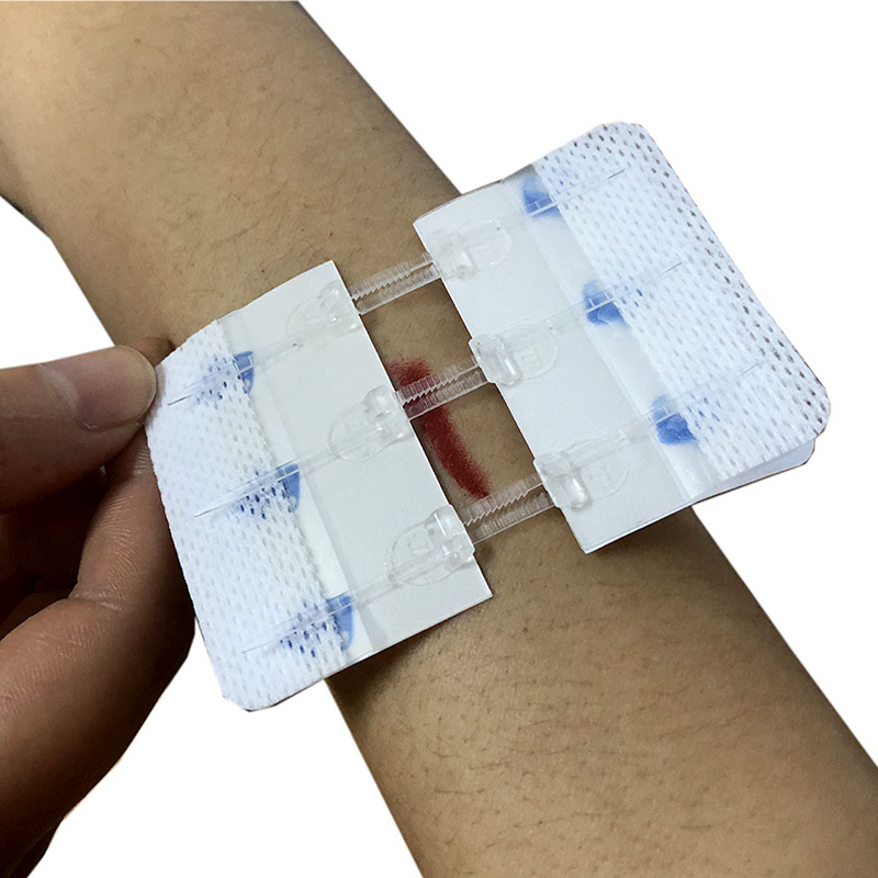 Hydrocolloid Zipstitch Zip Wound Closure Device Zipstitch Price